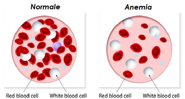anemia-rimedi-naturali