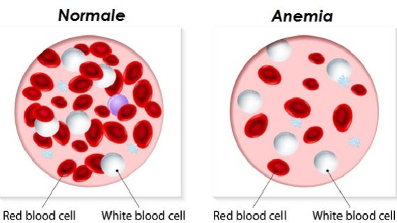 anemia-rimedi-naturali